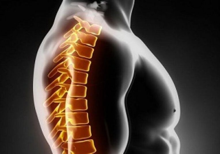 L'osteocondrosi toracica è accompagnata da dolore e disagio nella parte centrale della schiena