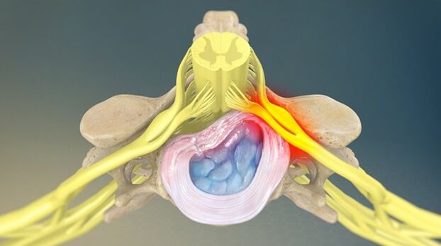 La sindrome radicolare come causa di lombalgia